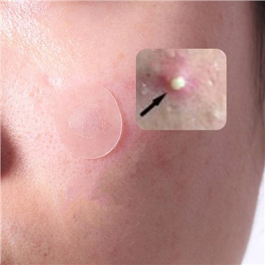 Fungal Acne Patch