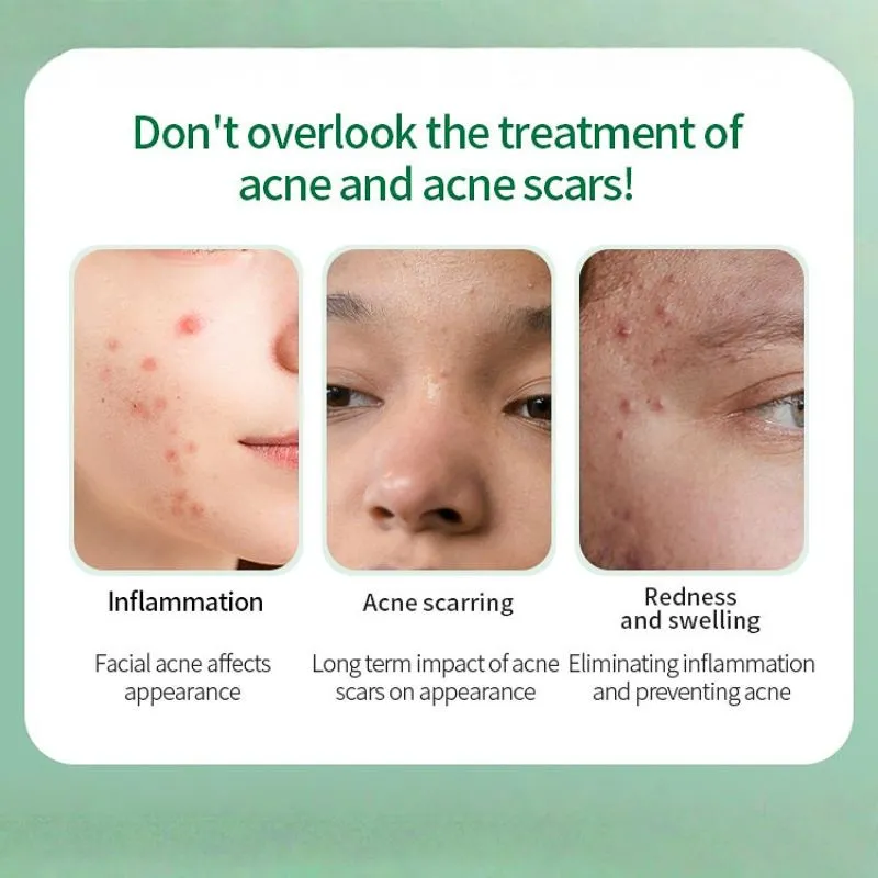 Microneedle acne patch 4 Microneedle acne patch 4